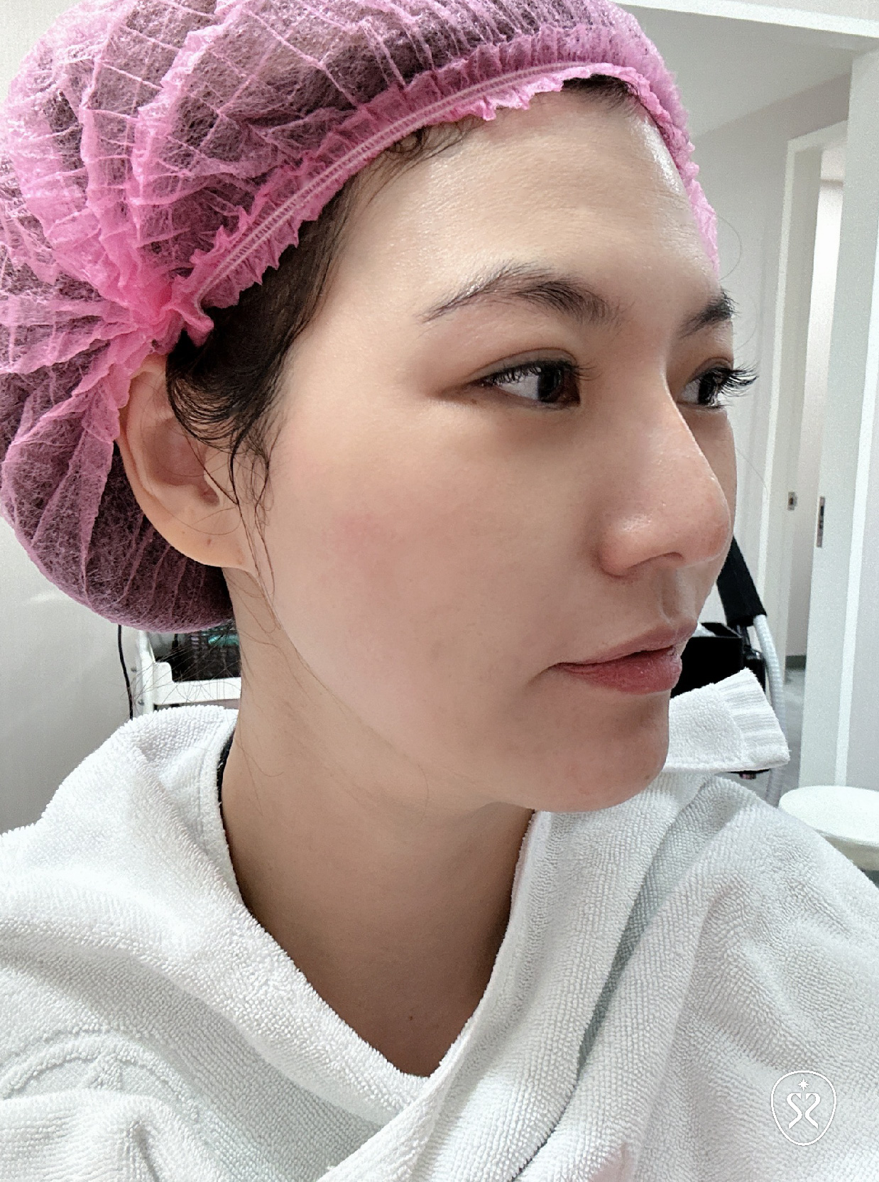 Q+立線音波為非侵入式療程，施打完緊緻拉提效果真的很不錯